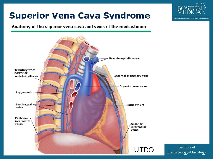 Superior Vena Cava Syndrome UTDOL 33 Section of Hematology-Oncology 
