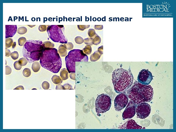 41 APML on peripheral blood smear Section of Hematology-Oncology 