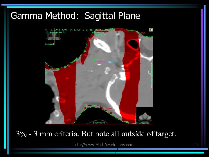 Gamma Method: Sagittal Plane 3% - 3 mm criteria. But note all outside of