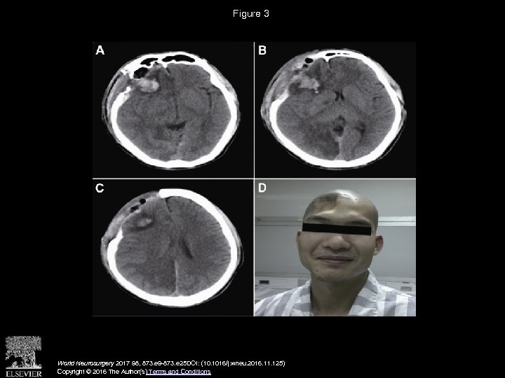 Figure 3 World Neurosurgery 2017 98, 873. e 9 -873. e 25 DOI: (10.