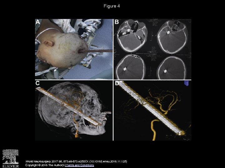 Figure 4 World Neurosurgery 2017 98, 873. e 9 -873. e 25 DOI: (10.