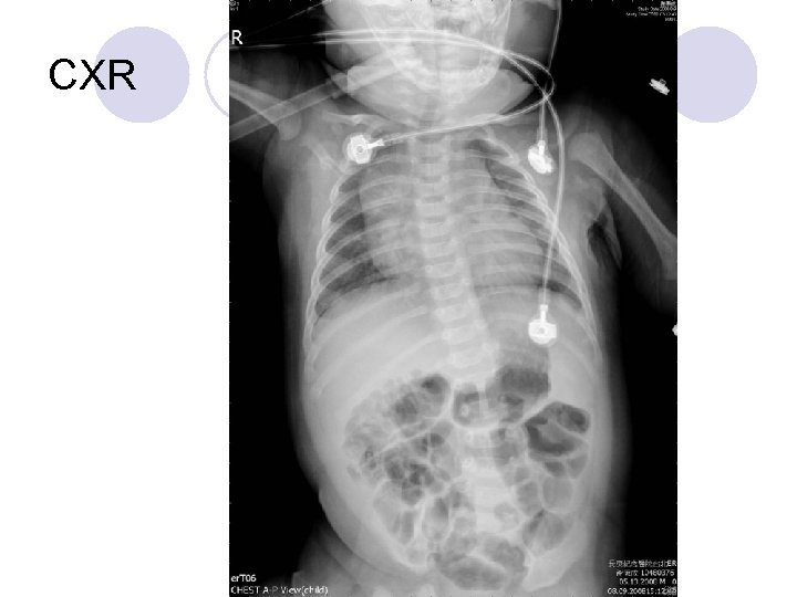 CXR 