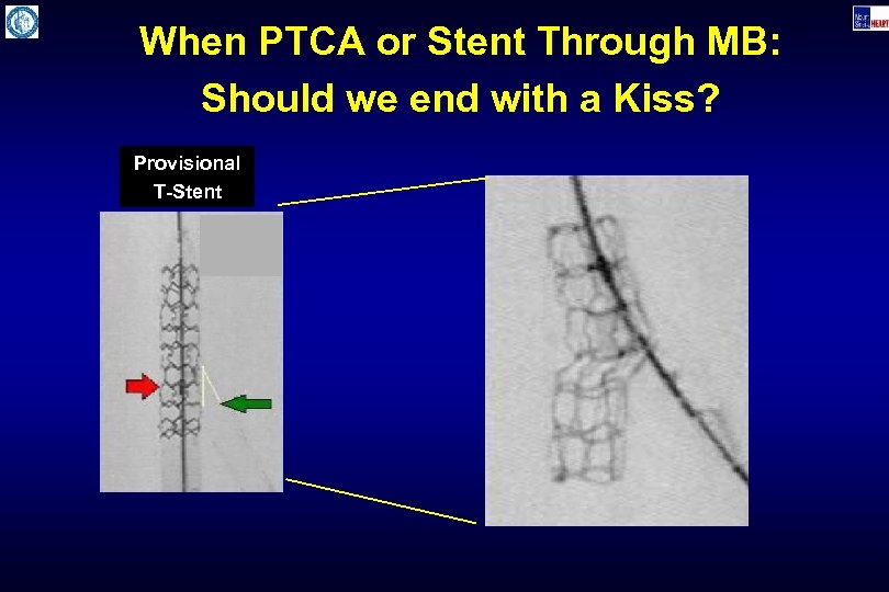 When PTCA or Stent Through MB: Should we end with a Kiss? Provisional T-Stent