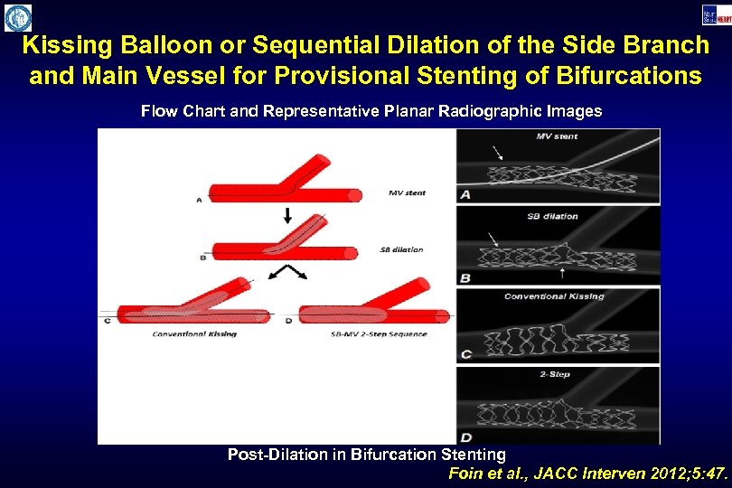 Kissing Balloon or Sequential Dilation of the Side Branch and Main Vessel for Provisional