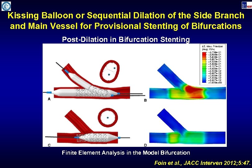 Kissing Balloon or Sequential Dilation of the Side Branch and Main Vessel for Provisional