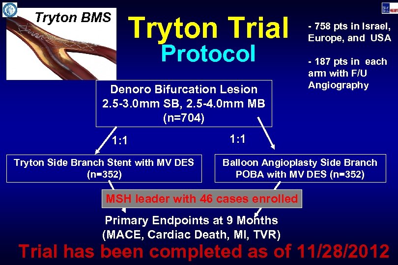 Tryton BMS Tryton Trial Protocol Denoro Bifurcation Lesion 2. 5 -3. 0 mm SB,