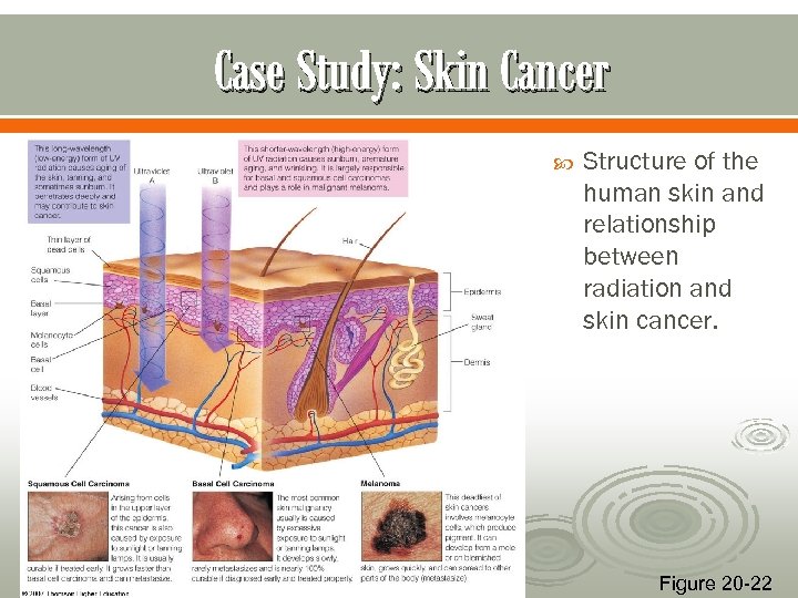 Case Study: Skin Cancer Structure of the human skin and relationship between radiation and