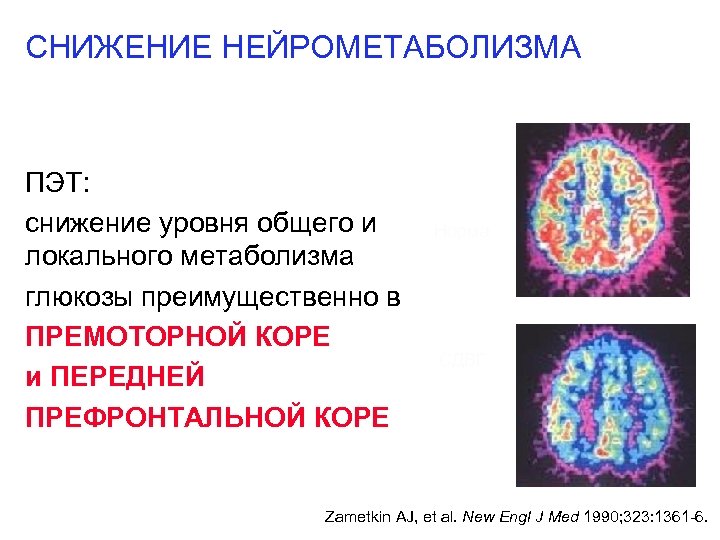 СНИЖЕНИЕ НЕЙРОМЕТАБОЛИЗМА ПЭТ: снижение уровня общего и локального метаболизма глюкозы преимущественно в ПРЕМОТОРНОЙ КОРЕ