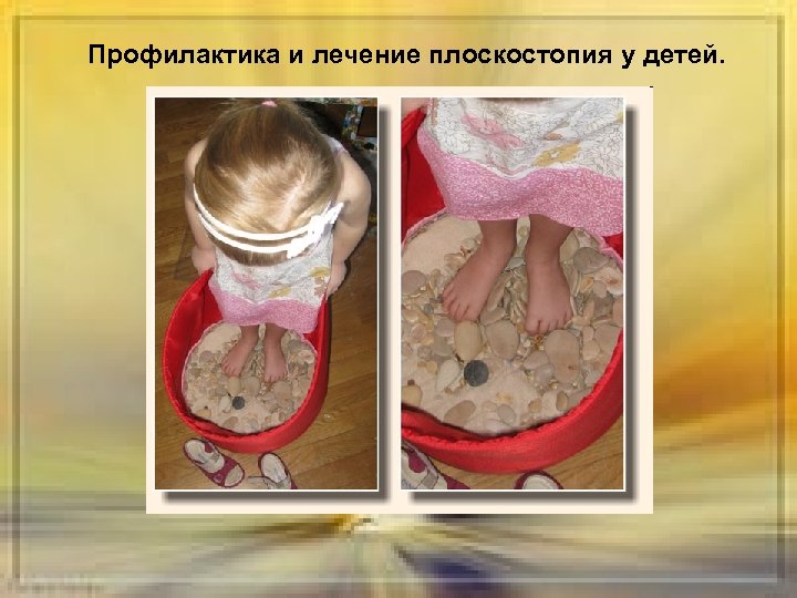 Профилактика и лечение плоскостопия у детей. 