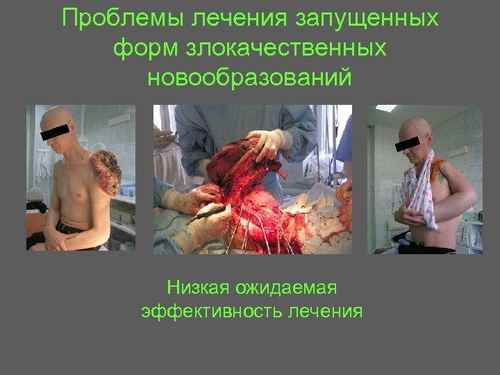 Проблемы лечения запущенных форм злокачественных новообразований Низкая ожидаемая эффективность лечения 