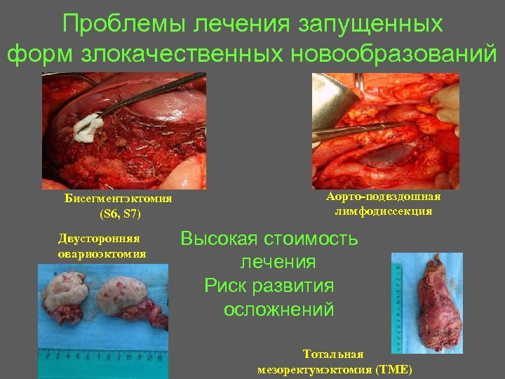 Проблемы лечения запущенных форм злокачественных новообразований Бисегментэктомия (S 6, S 7) Двусторонняя овариоэктомия Аорто-подвздошная
