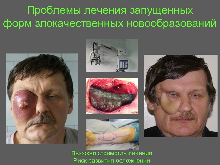 Проблемы лечения запущенных форм злокачественных новообразований Высокая стоимость лечения Риск развития осложнений 