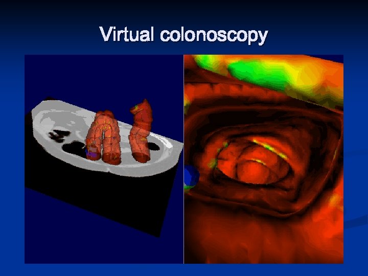 Virtual colonoscopy 