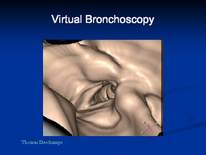 Virtual Bronchoscopy Thomas Deschamps 