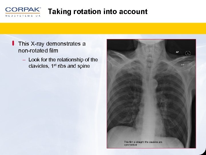 Taking rotation into account This X-ray demonstrates a non-rotated film ‒ Look for the