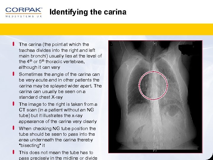 Identifying the carina The carina (the point at which the trachea divides into the
