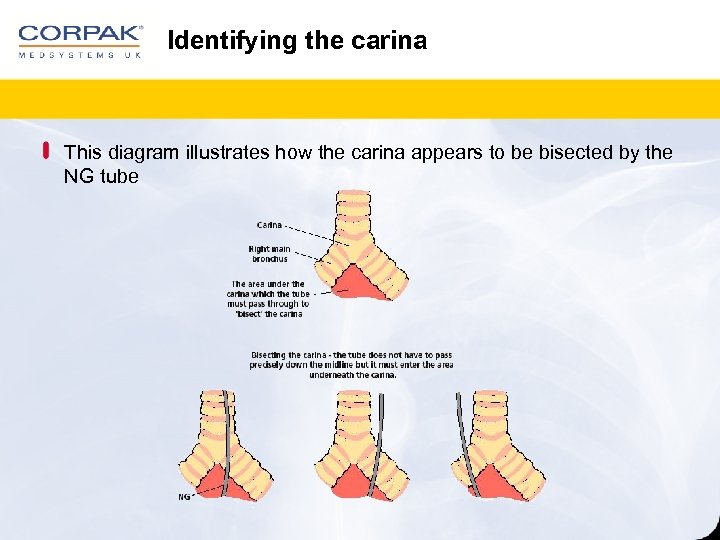Identifying the carina This diagram illustrates how the carina appears to be bisected by