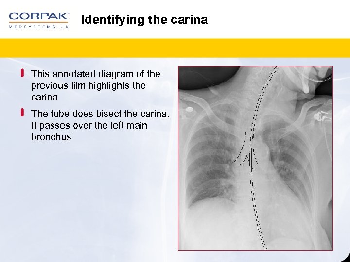 Identifying the carina This annotated diagram of the previous film highlights the carina The