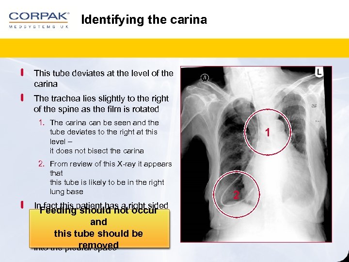 Identifying the carina This tube deviates at the level of the carina The trachea