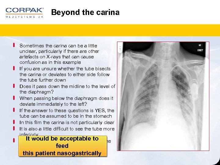 Beyond the carina Sometimes the carina can be a little unclear, particularly if there