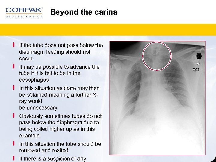 Beyond the carina If the tube does not pass below the diaphragm feeding should