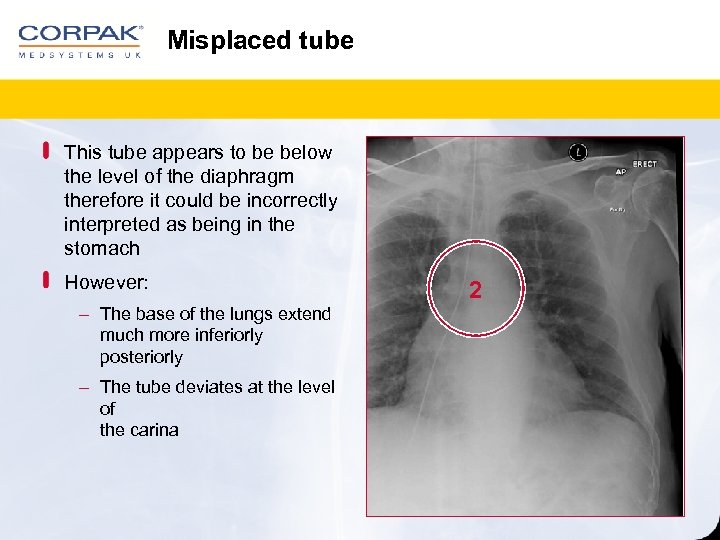Misplaced tube This tube appears to be below the level of the diaphragm therefore