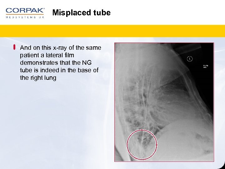 Misplaced tube And on this x-ray of the same patient a lateral film demonstrates