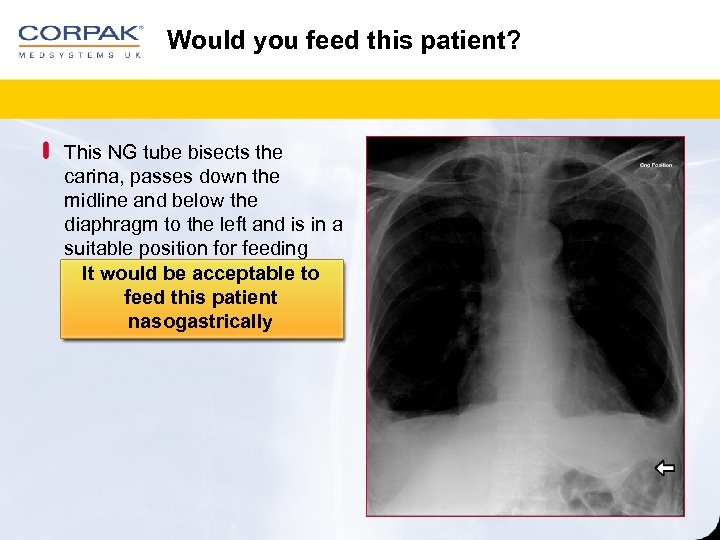 Would you feed this patient? This NG tube bisects the carina, passes down the