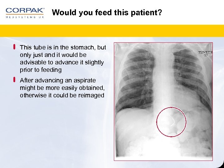 Would you feed this patient? This tube is in the stomach, but only just