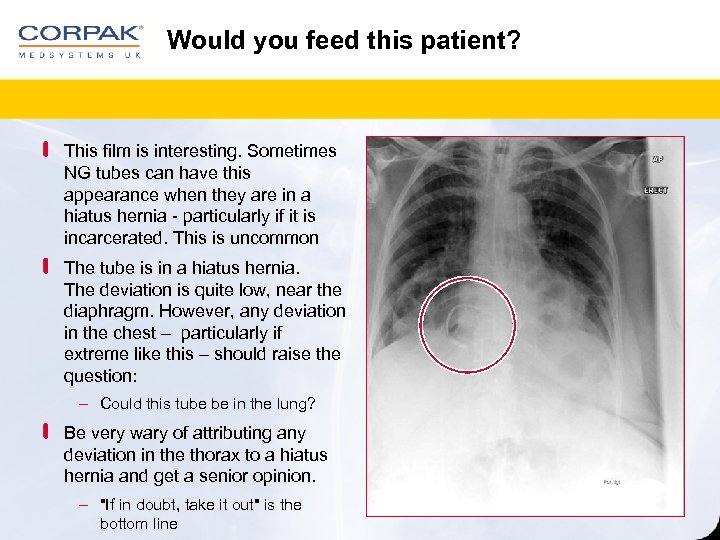 Would you feed this patient? This film is interesting. Sometimes NG tubes can have