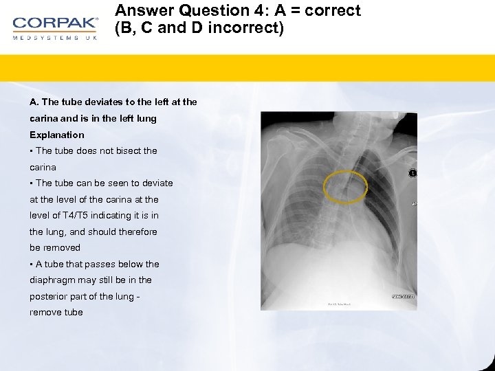 Answer Question 4: A = correct (B, C and D incorrect) A. The tube