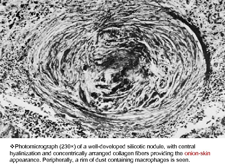 v. Photomicrograph (230×) of a well-developed silicotic nodule, with central hyalinization and concentrically arranged