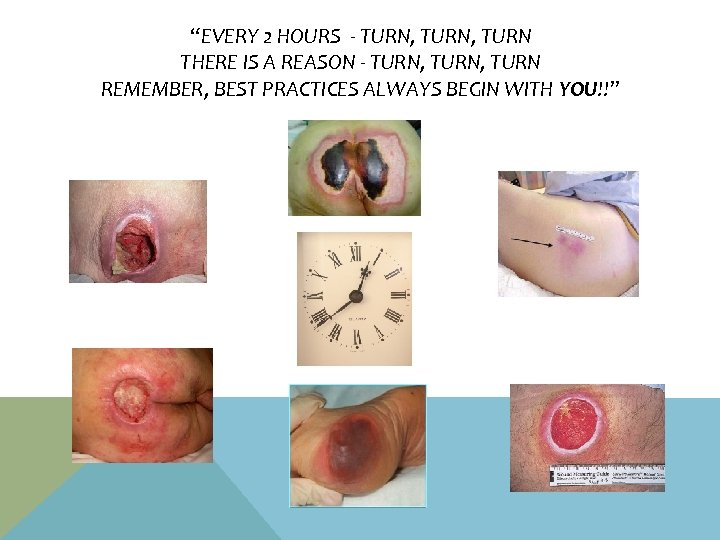 “EVERY 2 HOURS - TURN, TURN THERE IS A REASON - TURN, TURN REMEMBER,