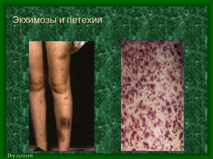 Экхимозы и петехии Dry purpura 