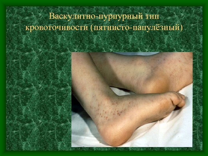 Васкулитно-пурпурный тип кровоточивости (пятнисто-папулёзный) 