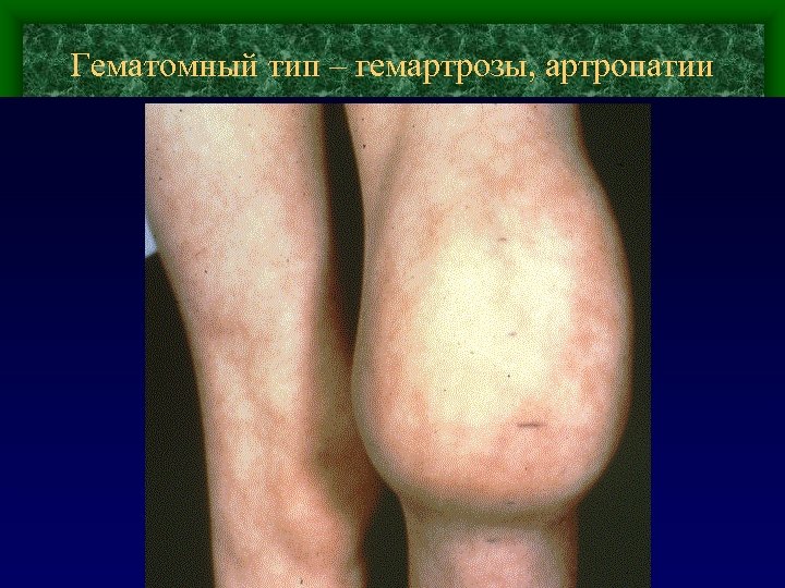 Гематомный тип – гемартрозы, артропатии 