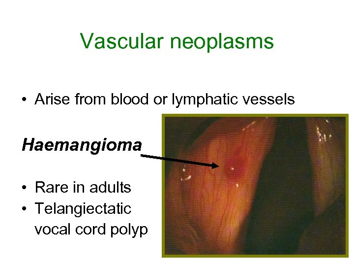 Vascular neoplasms • Arise from blood or lymphatic vessels Haemangioma • Rare in adults