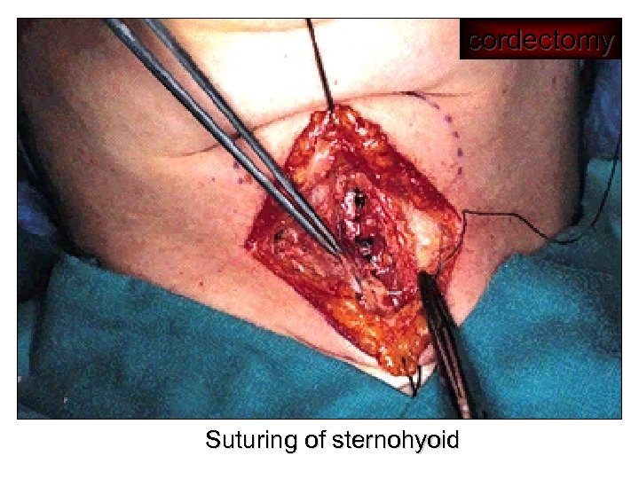 cordectomy Suturing of sternohyoid 