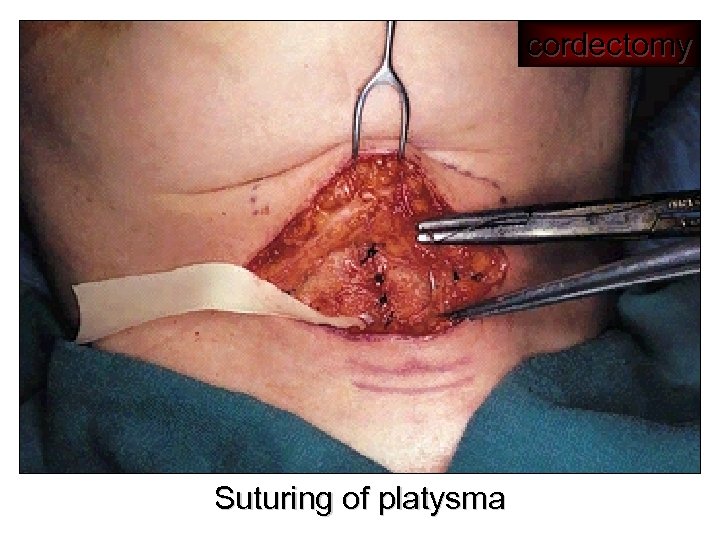 cordectomy Suturing of platysma 