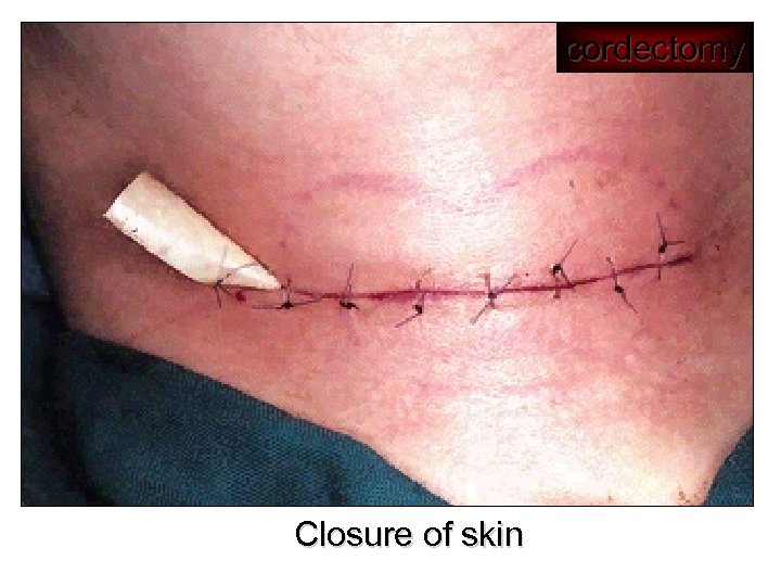 cordectomy Closure of skin 