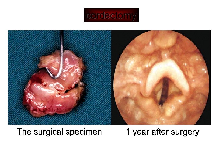 cordectomy The surgical specimen 1 year after surgery 