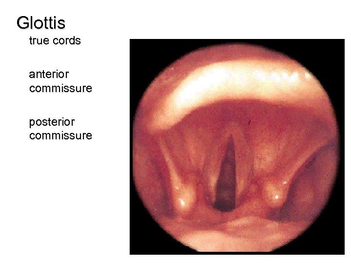 Glottis true cords anterior commissure posterior commissure 