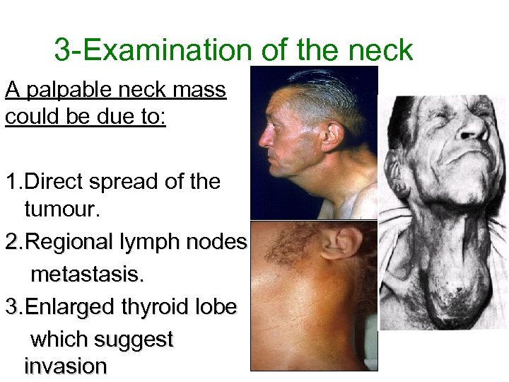 3 -Examination of the neck A palpable neck mass could be due to: 1.