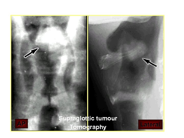AP Supraglottic tumour Tomography Lateral 