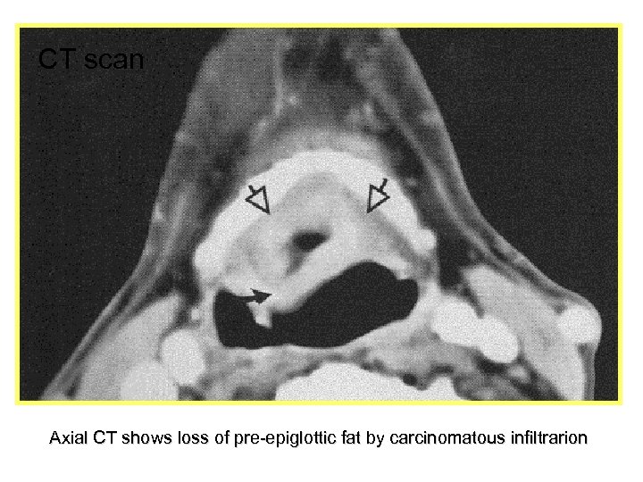 CT scan Axial CT shows loss of pre-epiglottic fat by carcinomatous infiltrarion 