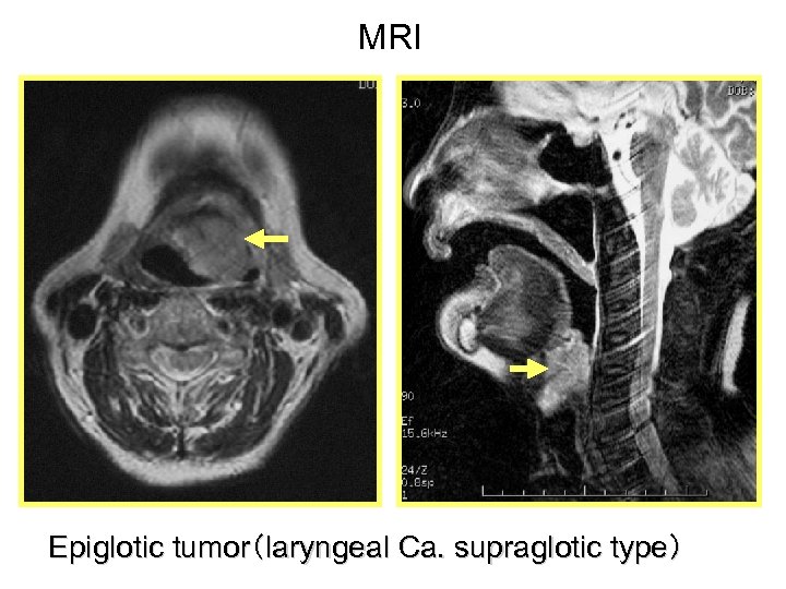 MRI Epiglotic tumor（laryngeal Ca. supraglotic type） 