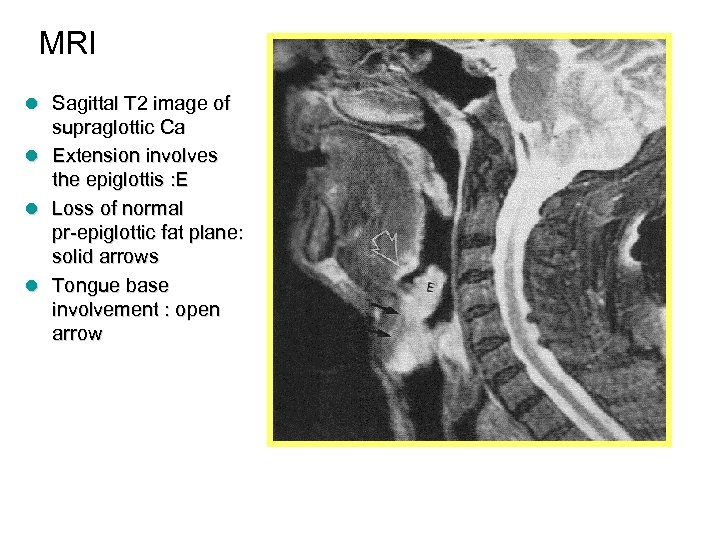 MRI l Sagittal T 2 image of l l l supraglottic Ca Extension involves