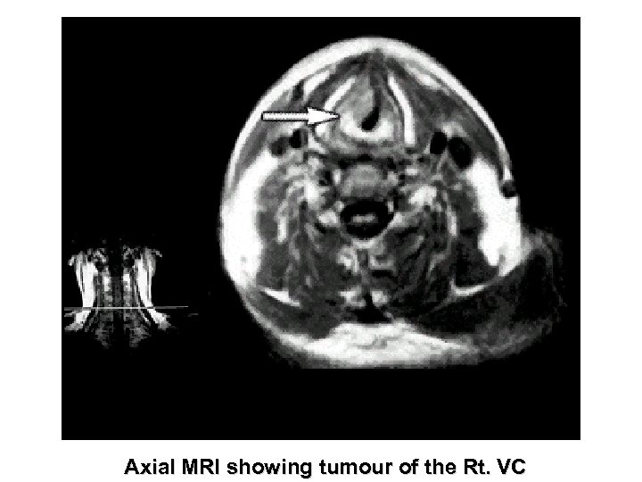 Axial MRI showing tumour of the Rt. VC 