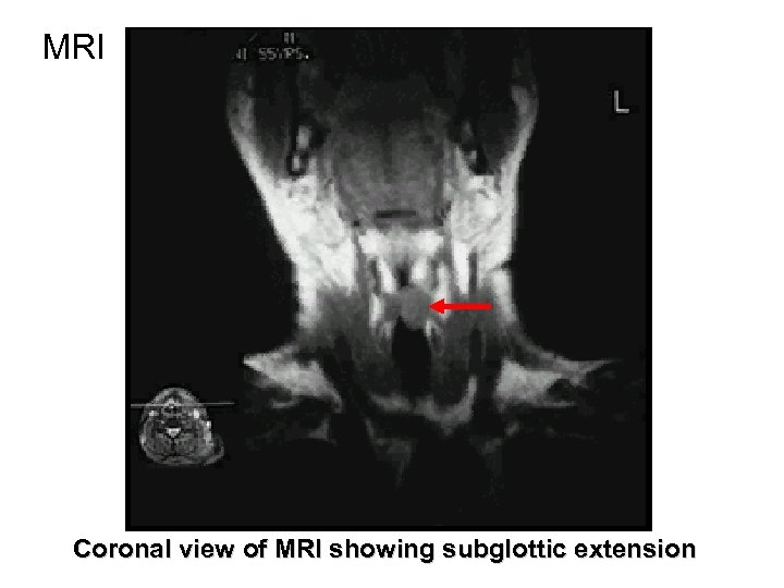 MRI Coronal view of MRI showing subglottic extension 