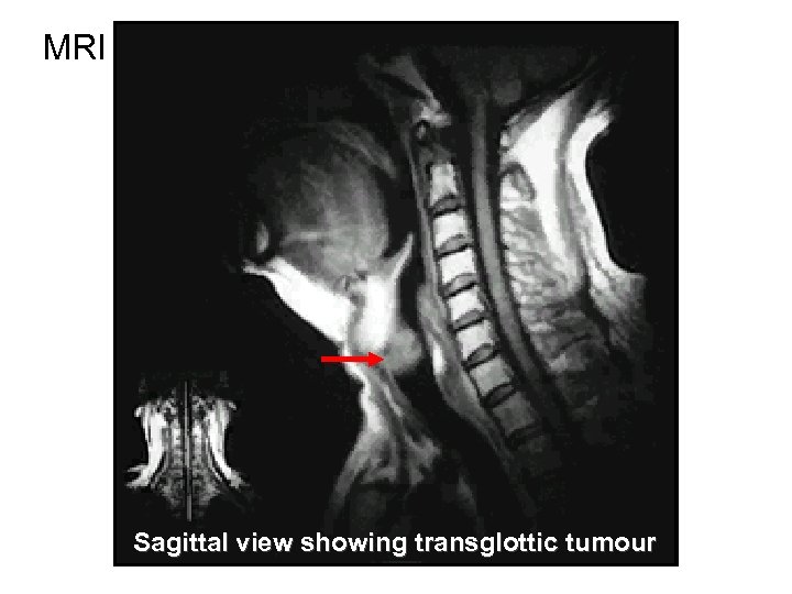 MRI Sagittal view showing transglottic tumour 